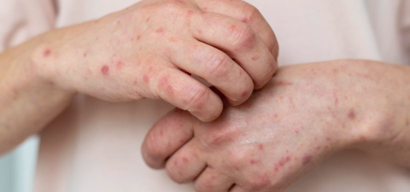 De niños a adultos: Ministerio de Salud declara alerta epidemiológica en Chile por sarampión